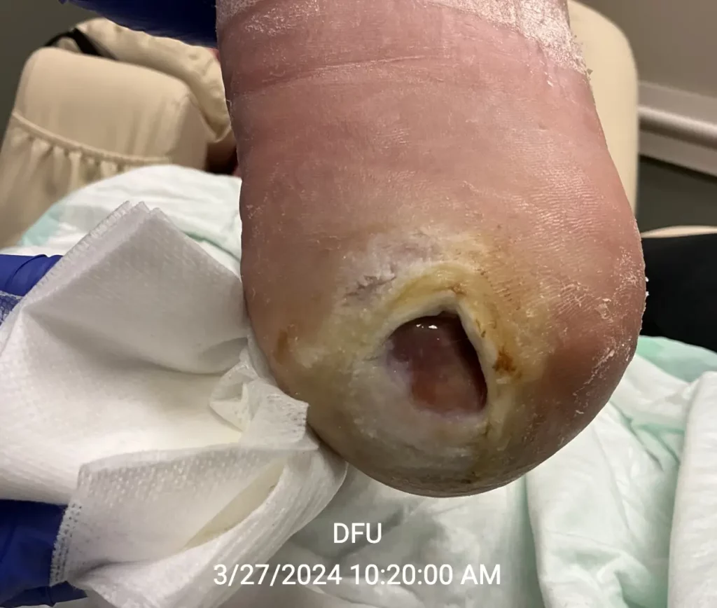 Diabetic foot ulcers - 3/27/24