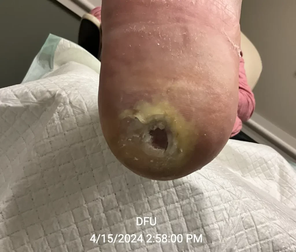 Diabetic foot ulcer - 4/15/2024