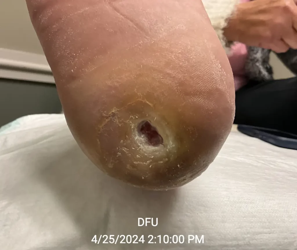 Diabetic foot ulcer - 4/25/24