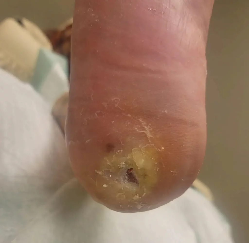 Diabetic foot ulcer - 5/20/24