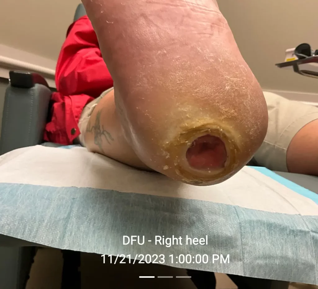 Diabetic foot ulcer - 11/21/2023