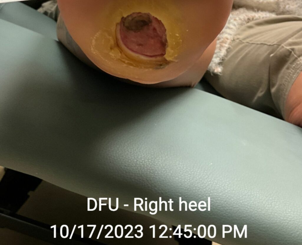 Diabetic foot ulcer - 10/27/2023